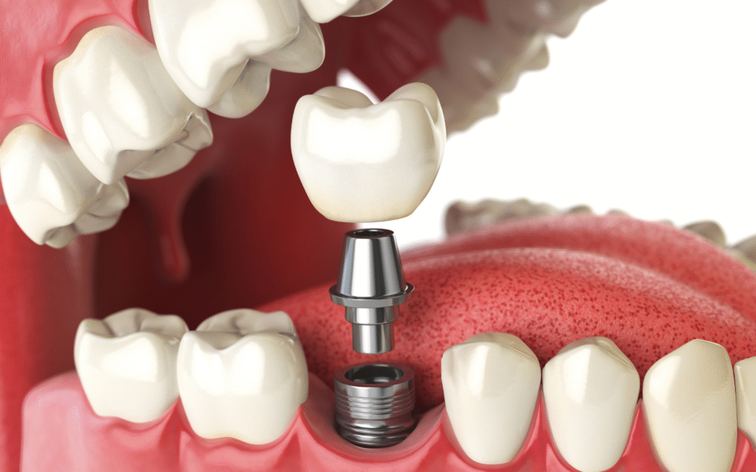 Best Dental Implant Treatments in Hyderabad | Restore Your Smile