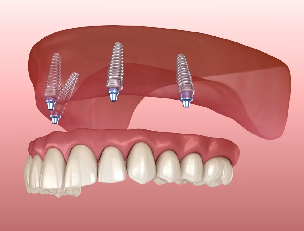 implant supported dentures