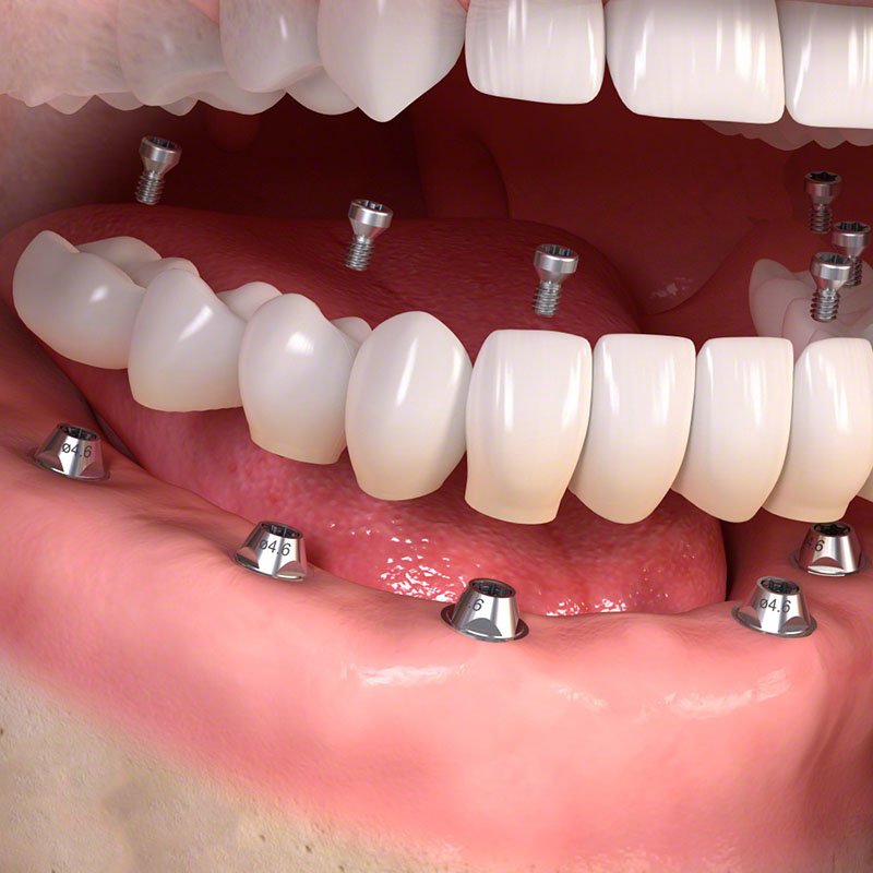 full-arch-implants