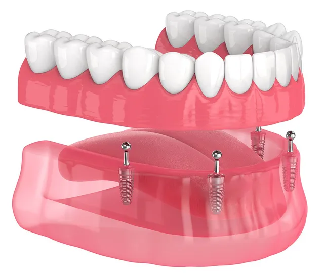 implant supported dentures