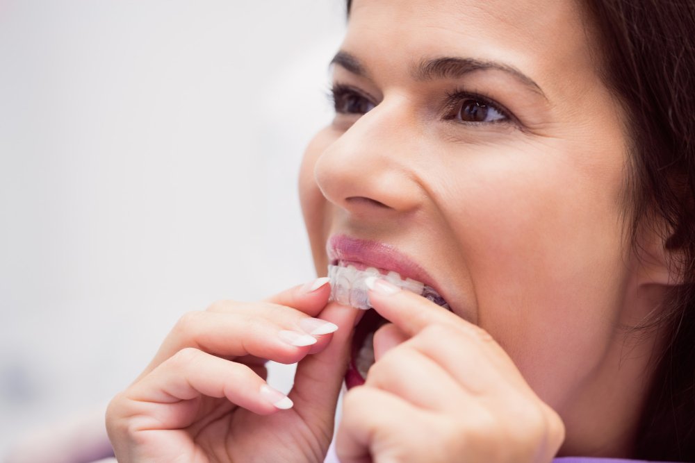 Know About Invisible Aligners: Benefits, Process, and Care Tips
