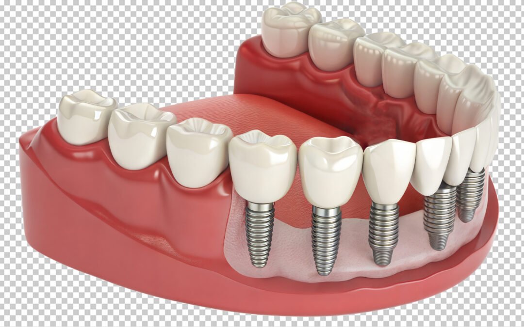Dental Implants: What They Are, Benefits, Procedure, and Aftercare
