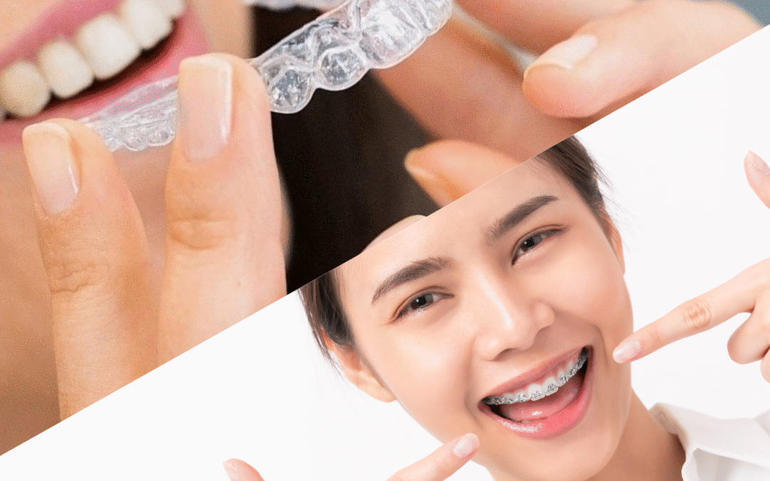 Do You Need Braces or Clear Aligners? Find Out Now